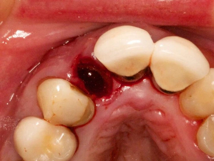 Normal Socket After Tooth Extraction Picture 3