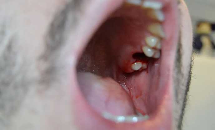 Normal Socket After Tooth Extraction Picture 2