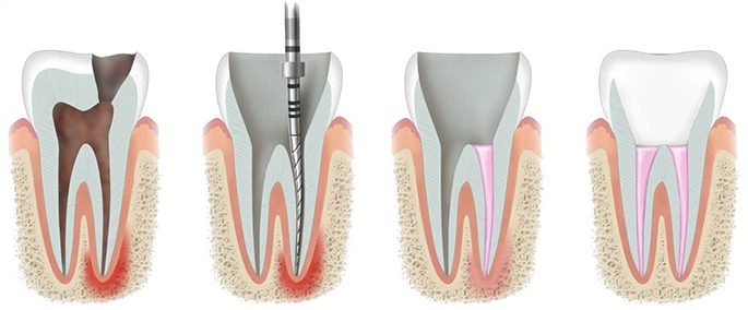 Root Canal Steps