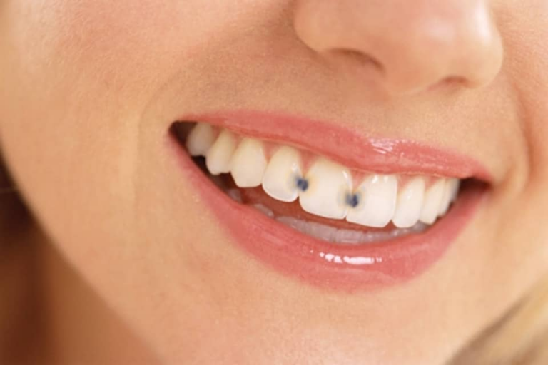 cavities-between-teeth-what-to-do-web-dmd