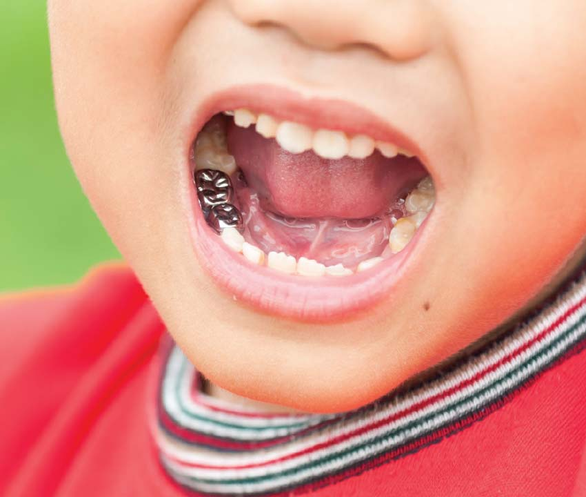 Silver Teeth: Prefabricated Stainless Steel Dental Crown for Primary Teeth