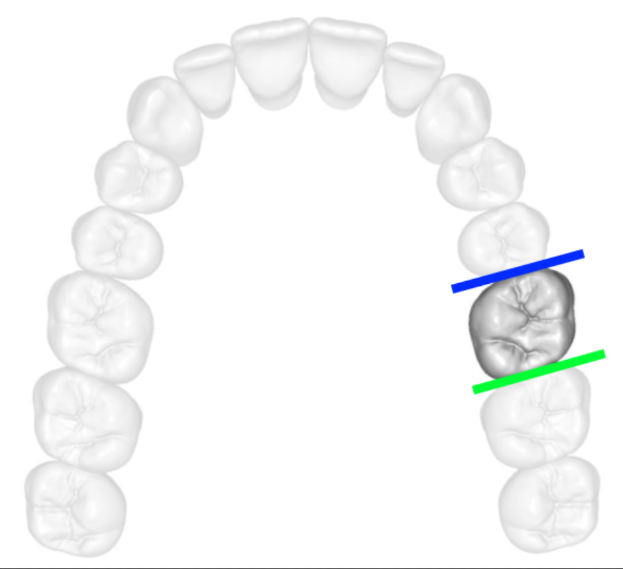 Teeth Surfaces: Distal vs Mesial