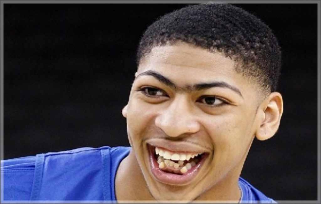 Anthony Davis' Teeth: Before