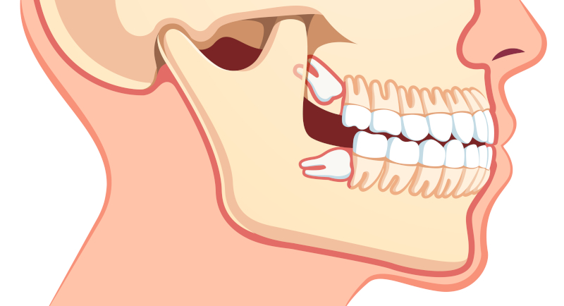 Are Your Wisdom Teeth Fully Impacted?