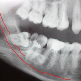 How Far Have the Wisdom Teeth Roots Grown?