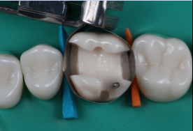 MODL Tooth Preparation