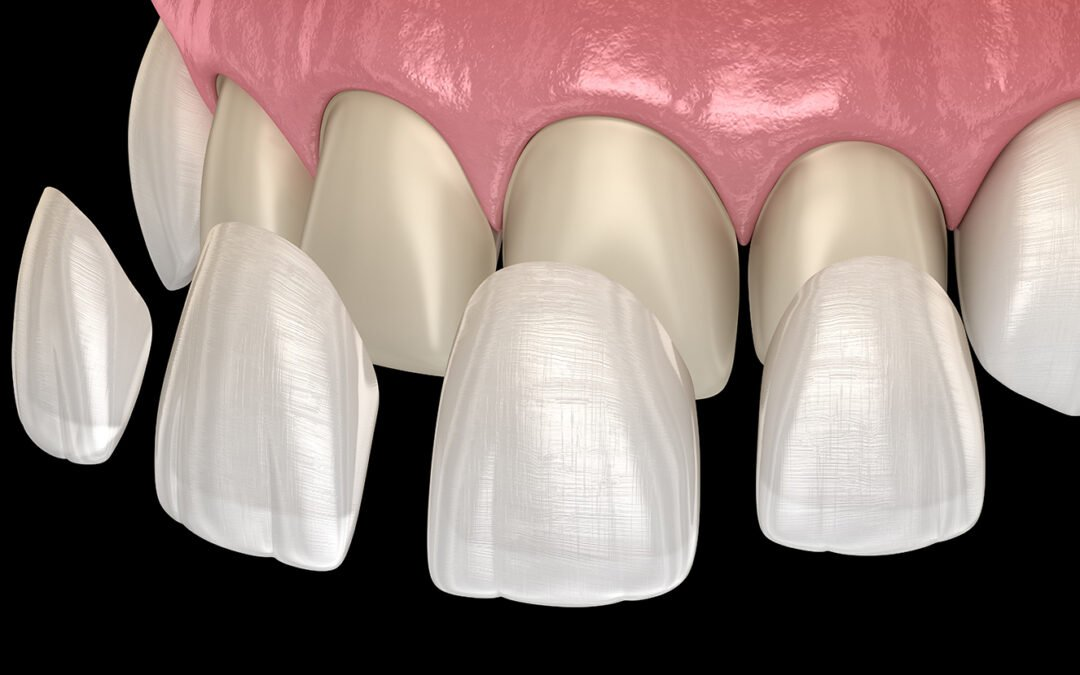 How Much do Veneers Cost?  DMD