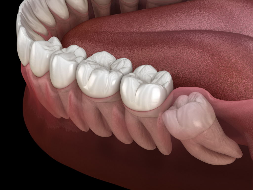 Benefits Of Keeping Wisdom Teeth Dentists Answer Web Dmd