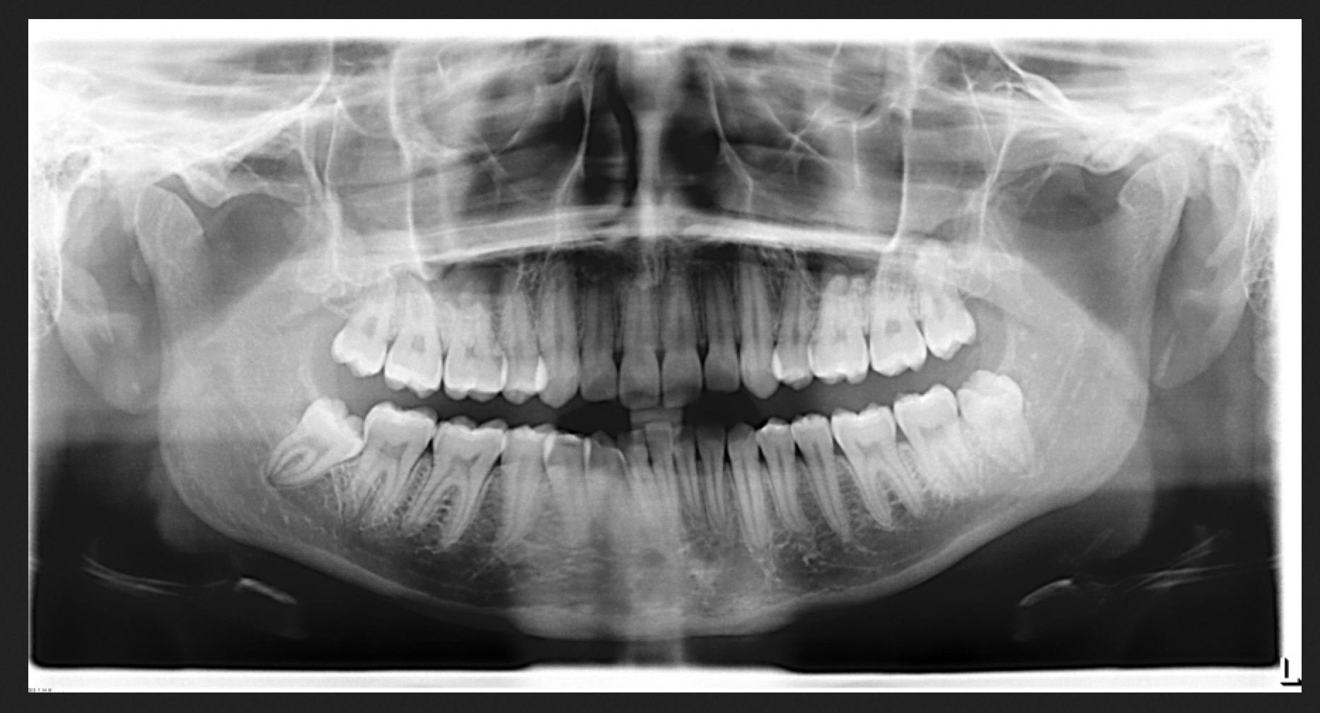 Wisdom Teeth XRays What to Expect  DMD