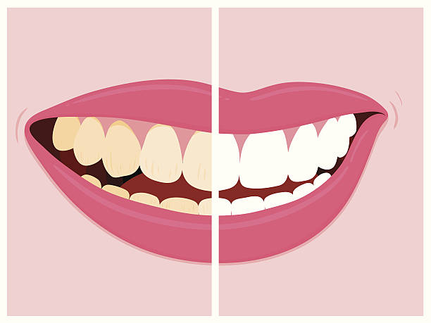 Cavity vs Stain: What's the Difference?