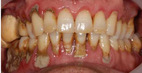 Calcium Buildup on Teeth