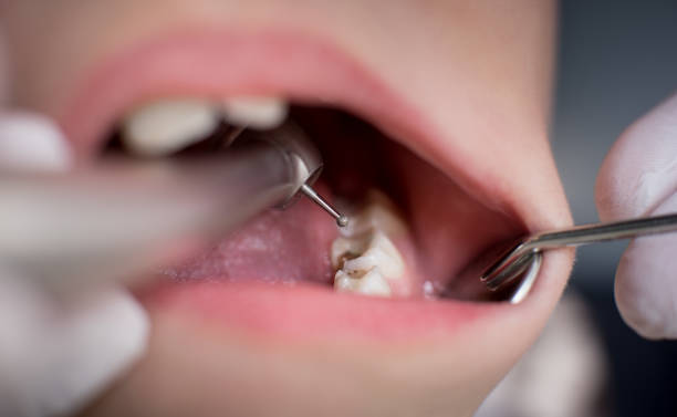 Are Cavities Contagious? 