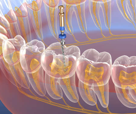 Root Canal vs. Implant: What is a Root Canal?