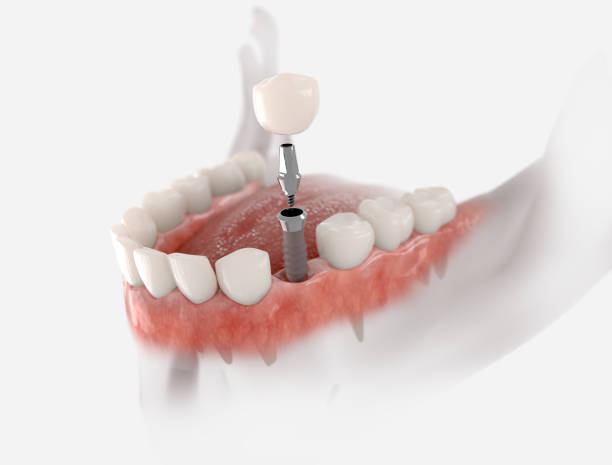 Dental Bridge vs Implant: What is an Implant?