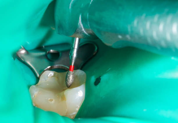 Pulpotomy: Alternative to Root Canal