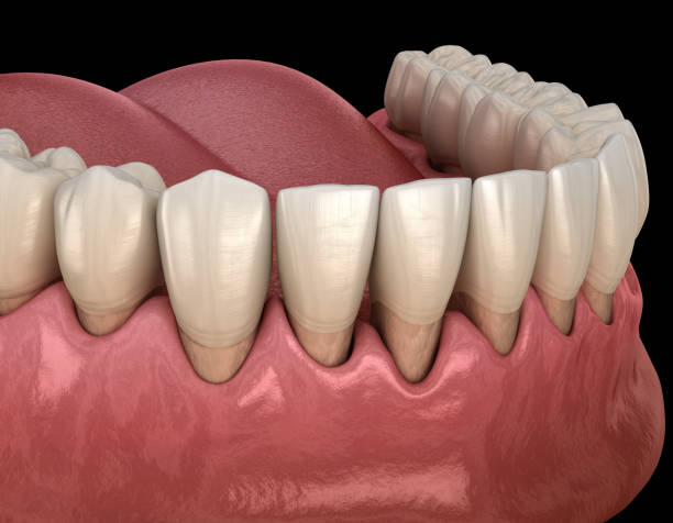 How to Stop Receding Gums From Getting Worse