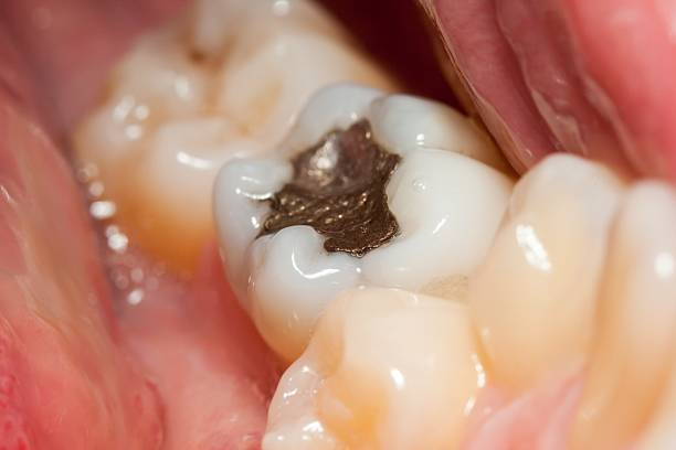 Do Cavity Fillings Hurt Web DMD