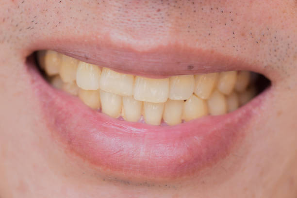 Are Yellow Teeth Healthy? It Depends