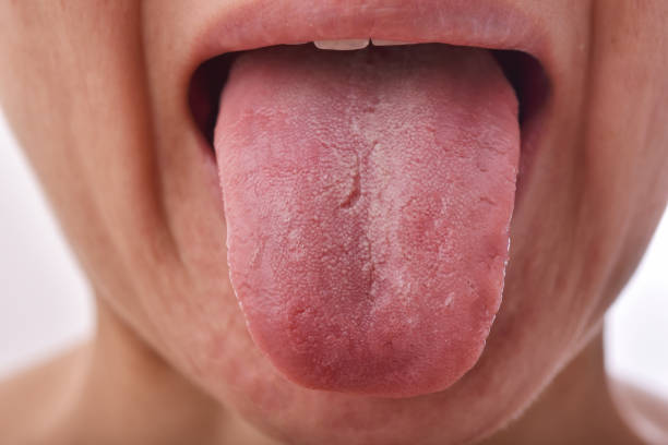 The Itchy Truth: Why Your Tongue is Itchy