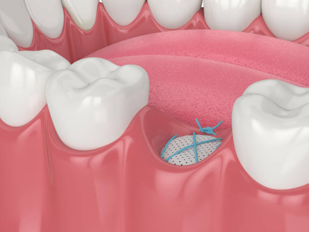 Dental Bone Grafting