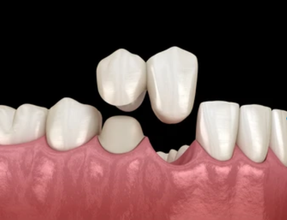 Cantilever dental bridge