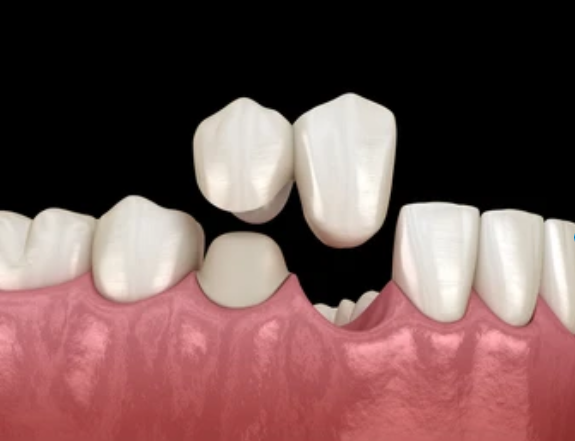 Dental Bridge Complete Guide Web Dmd