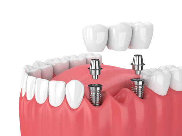 Implant-supported dental bridge