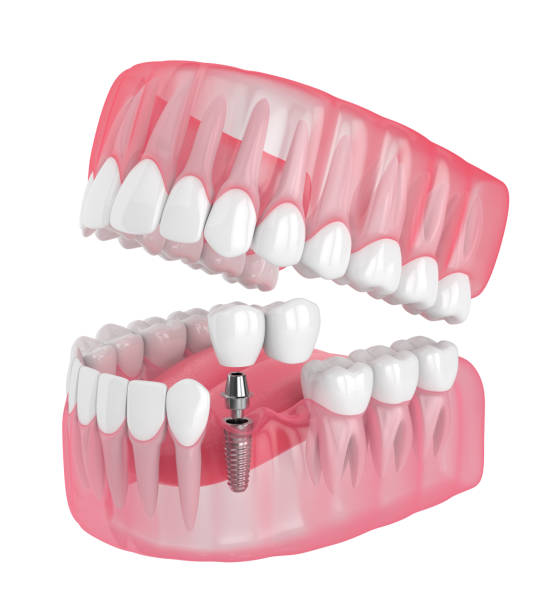 Dental Bridge