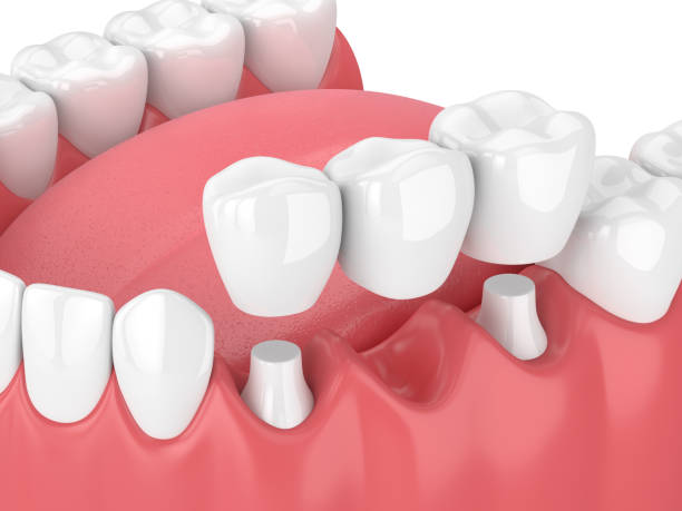 Traditional fixed dental bridge