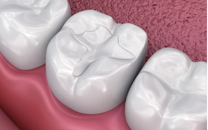 Composite Resin (Tooth-Colored) Direct Filling