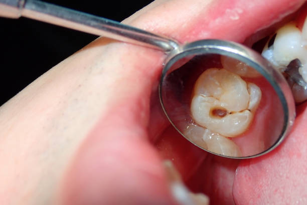 Dental Fillings: Cavities