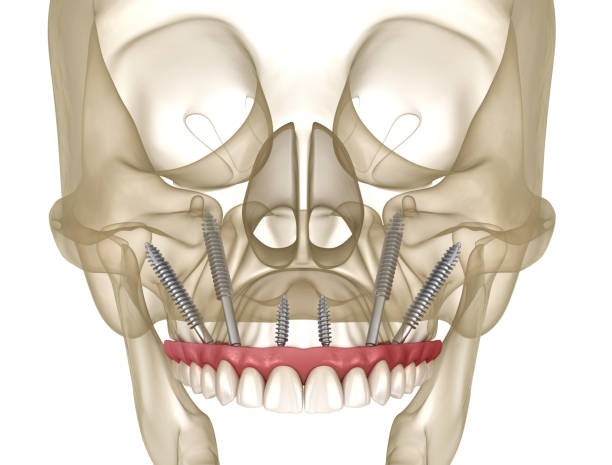 Zygomatic Implants