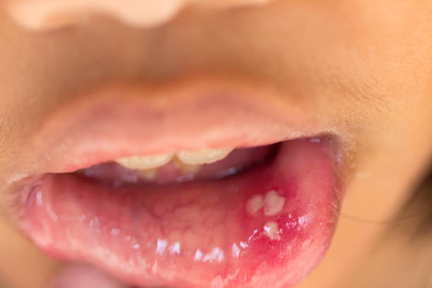 Can You Pop Canker Sores?