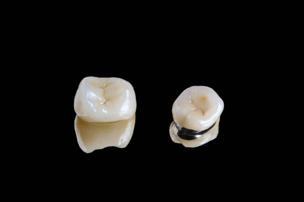 PFM Dental Crown