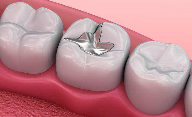 Amalgam (Silver) Direct Filling