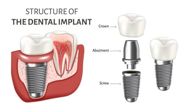 What are Dental Implants