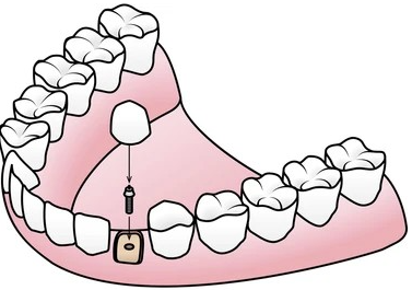 Endosteal Implants