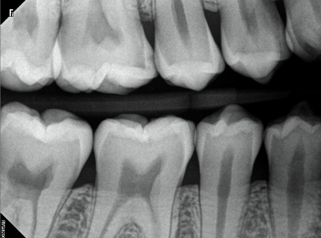 X-Rays of Teeth With Moderate Cavities