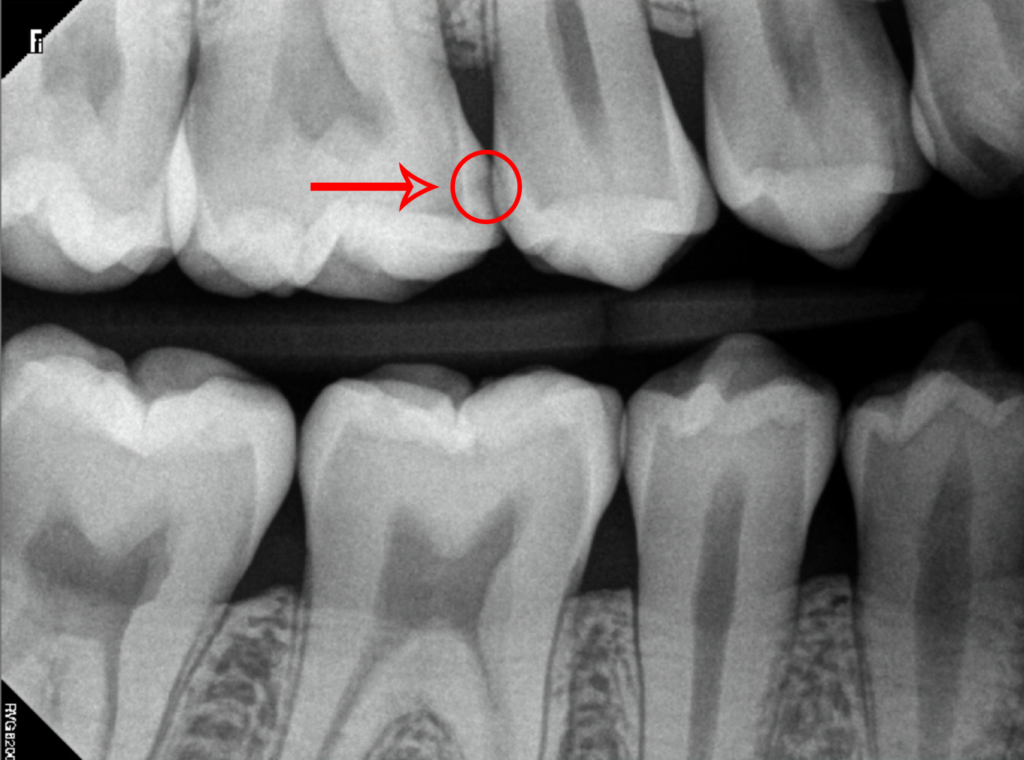 X-Rays of Teeth With Moderate Cavities Marked Up