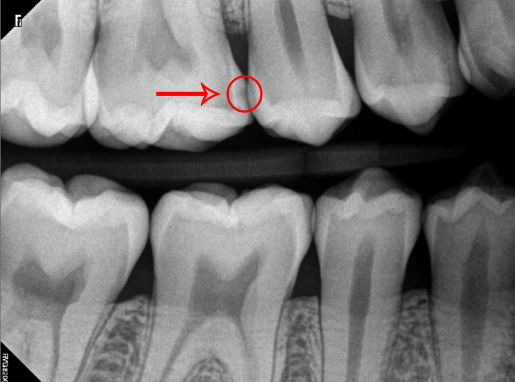 Dental X-Ray of Cavities Between Teeth