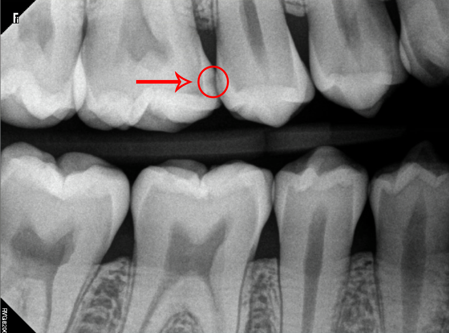 X-Rays of Teeth With Severe Cavities Marked