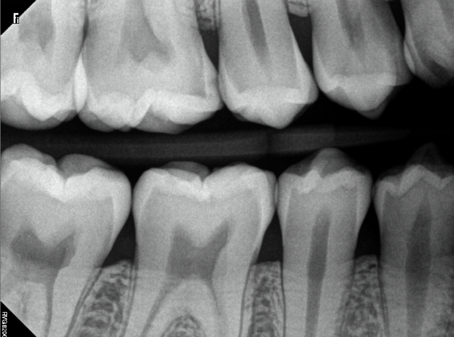 X-Rays of Child Teeth With Severe Cavities