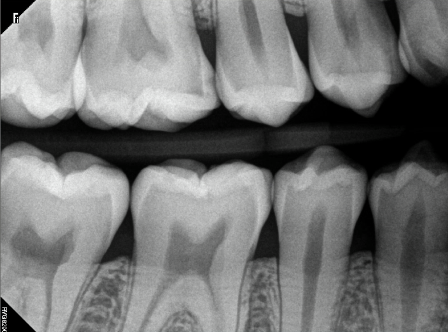 What Does a Cavity Look Like on an X-Ray? - Web DMD