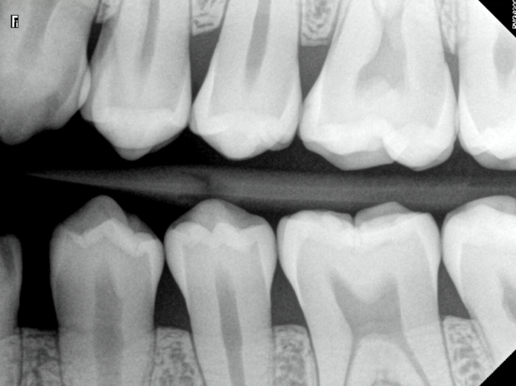 X-Ray of Teeth Under "Observation"