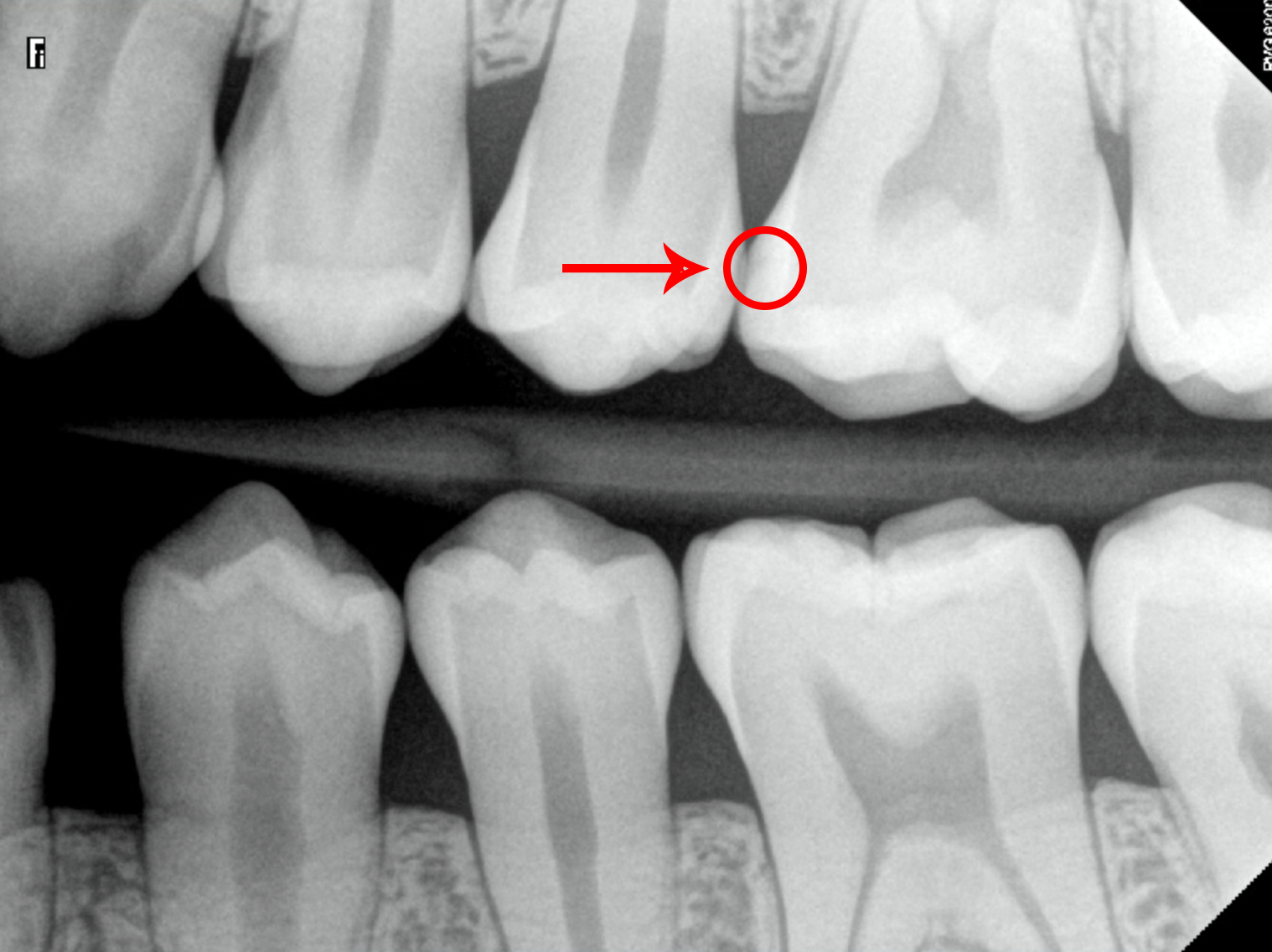 X-Rays of Teeth With Moderate Cavities Marked Up
