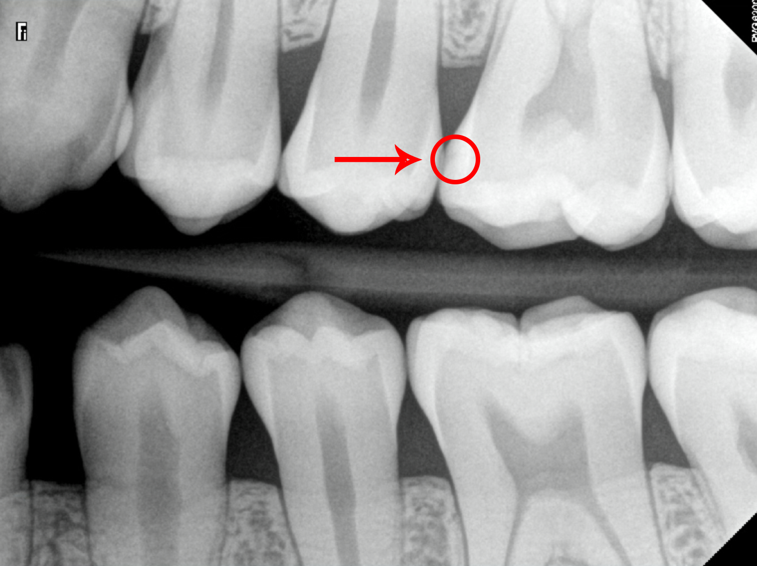 What Does a Cavity Look Like on an X-Ray? - Web DMD