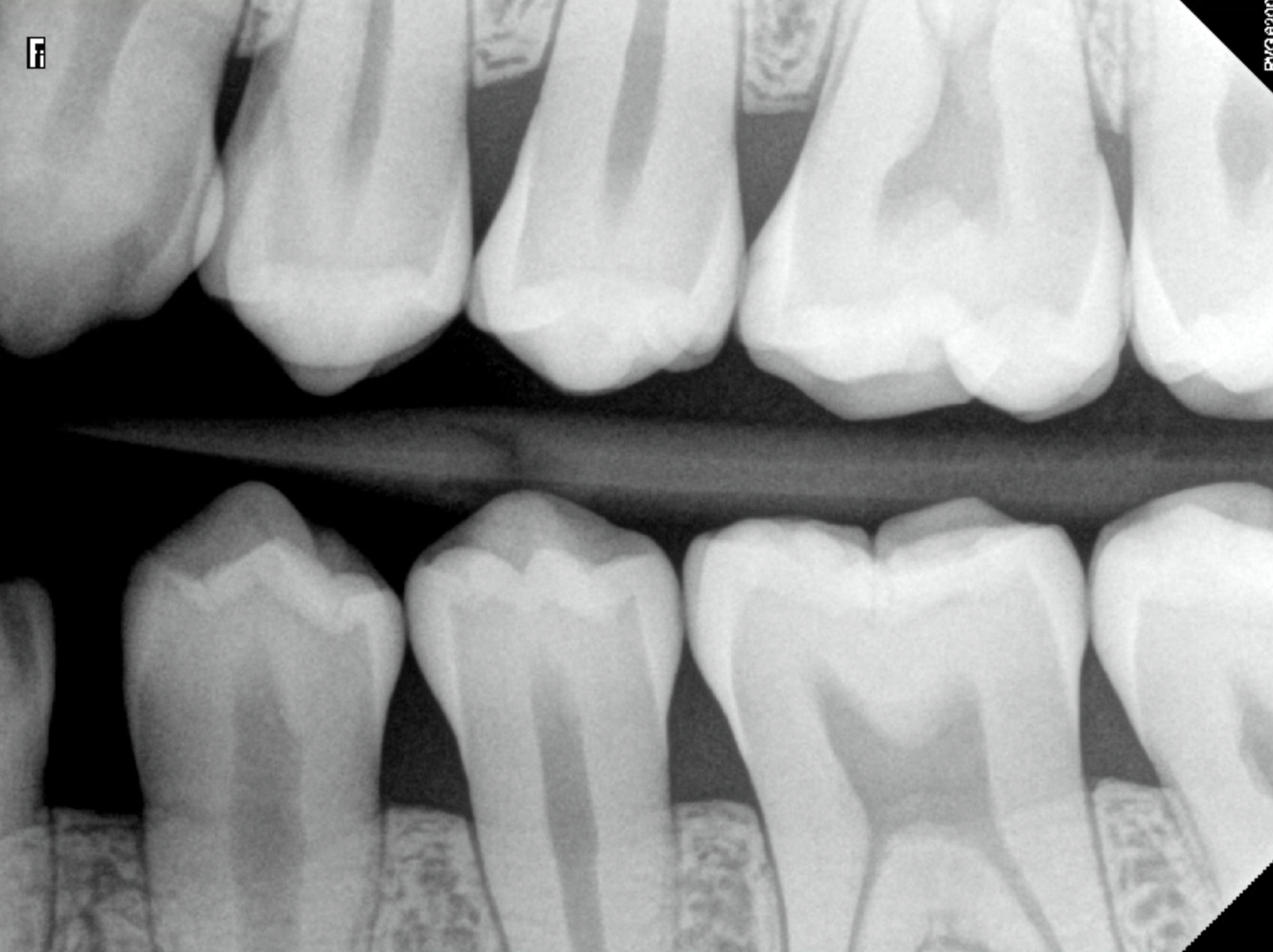 X-Rays of Child Teeth With Moderate Cavities Marked Up