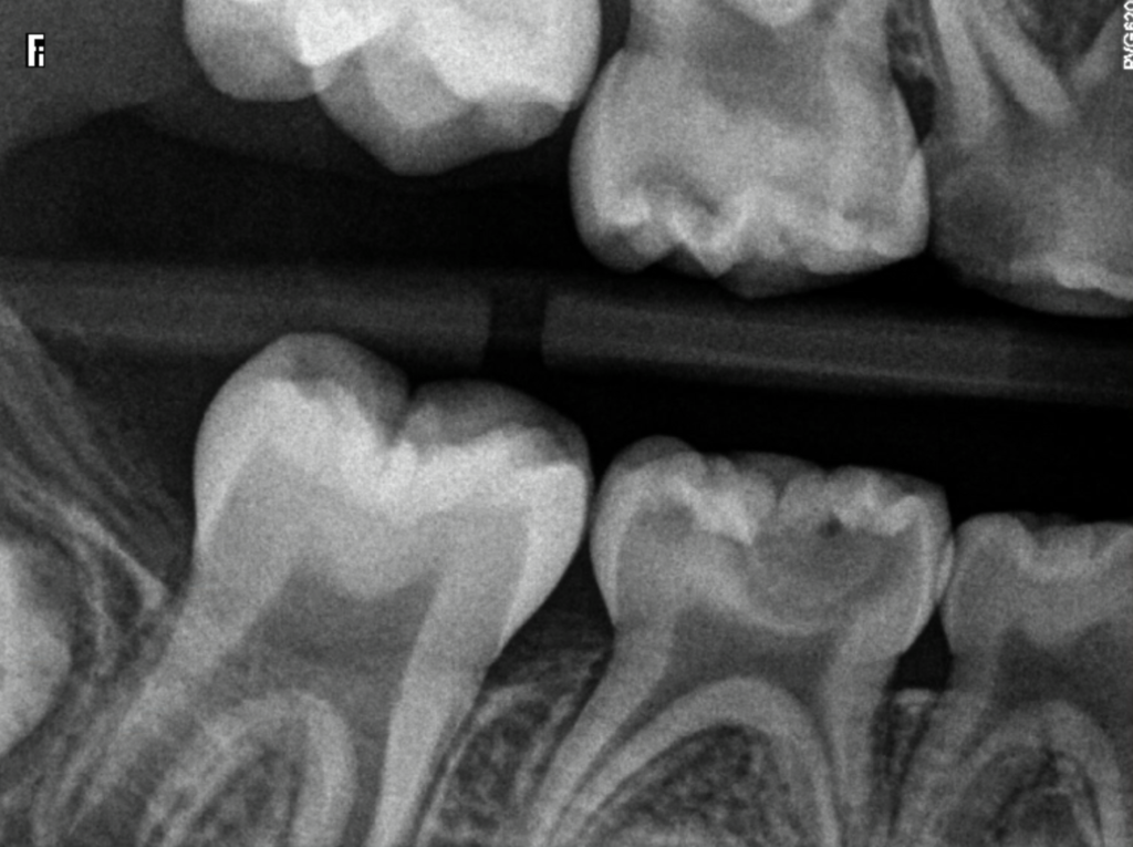 X-Rays of Child Teeth With Moderate Cavities