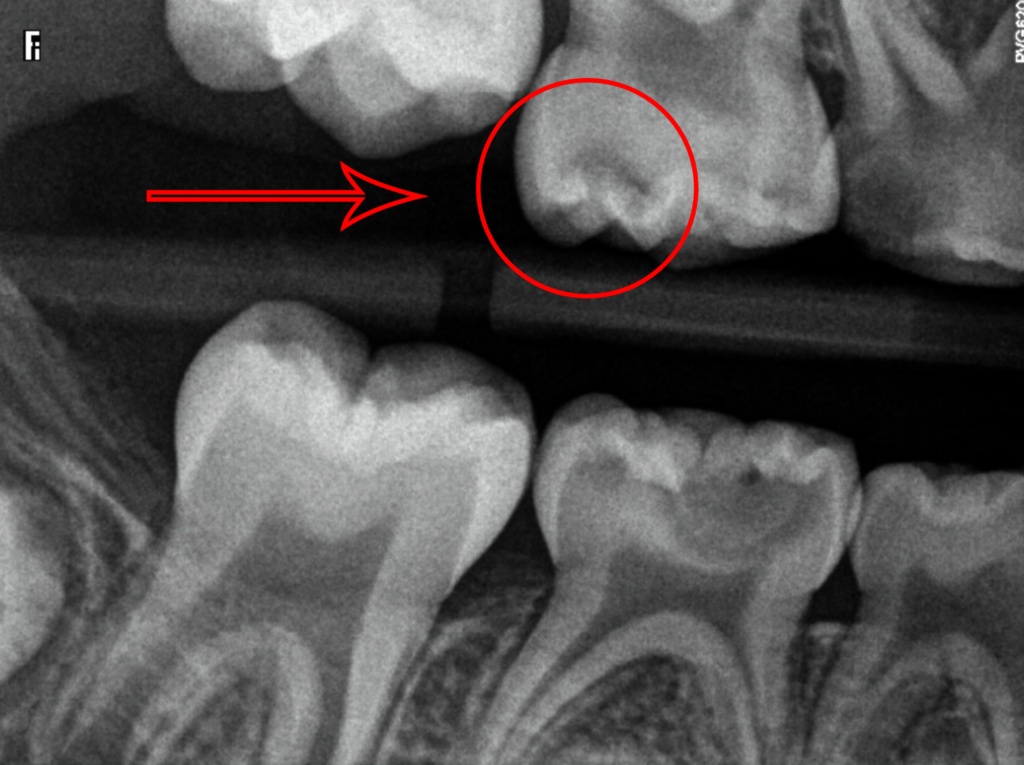 Cavity on X-Ray
