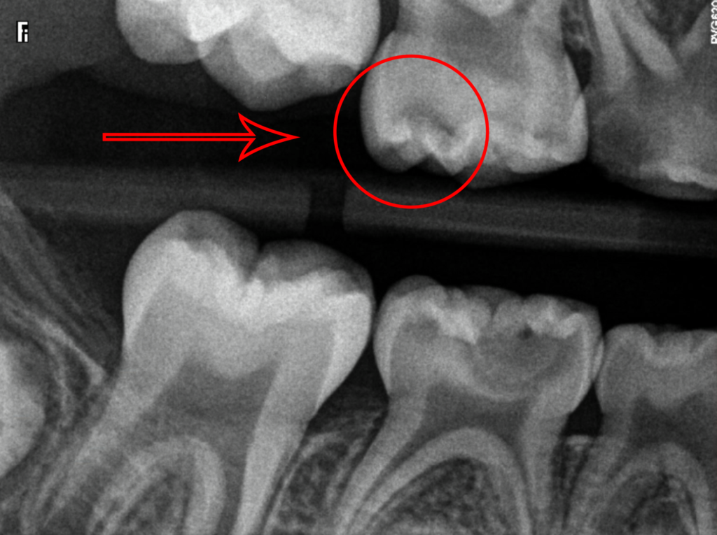 X-Rays of Child Teeth With Moderate Cavities Marked Up